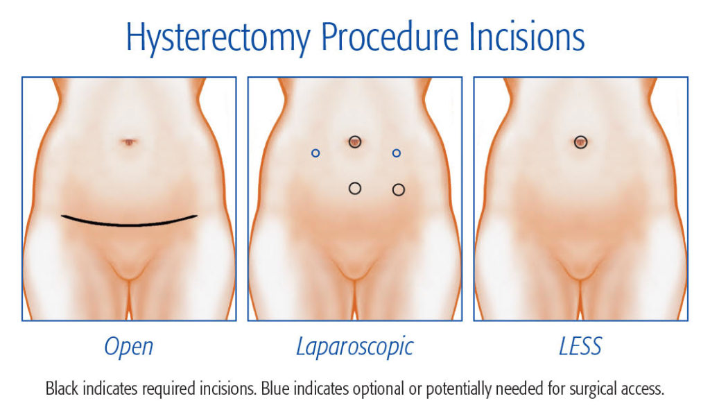 Hysterctomy procedure incision